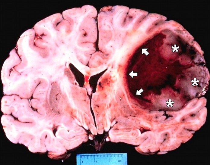 Glioblastoma-Multiforme