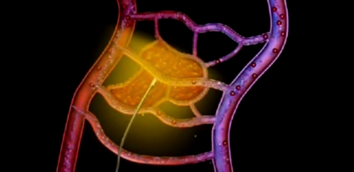 cancer-prostata
