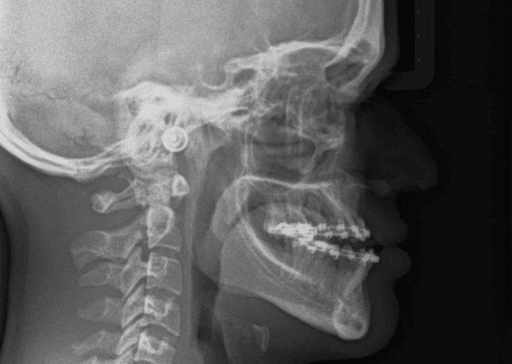 ferpa on X: prognatismo mandibular (maxilar inferior proeminente