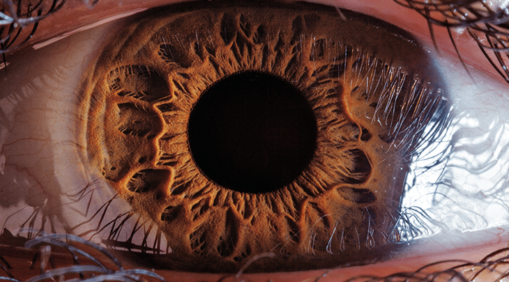 Considerações gerais sobre doenças da retina - Distúrbios