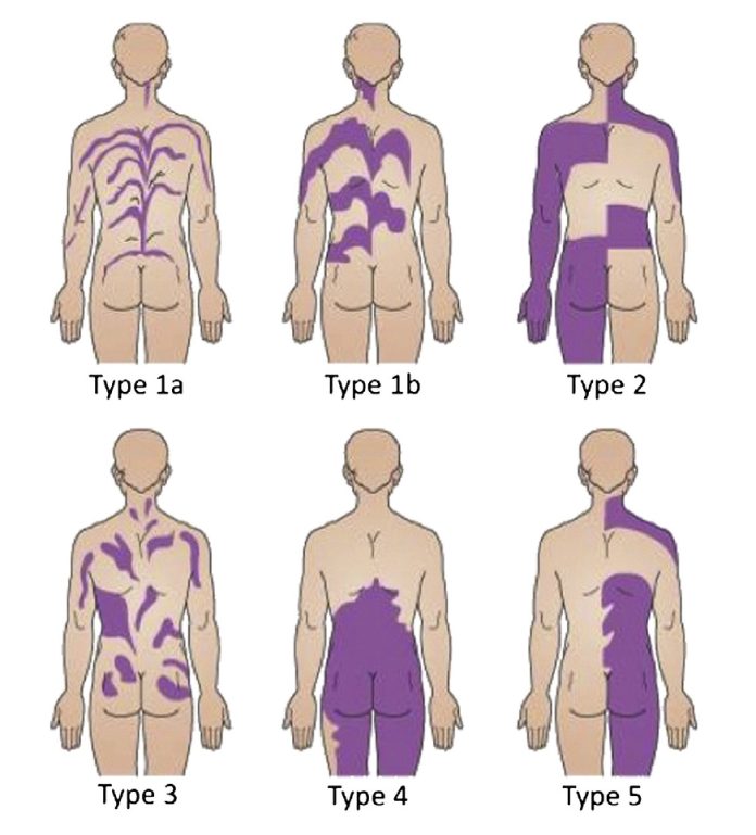 Humans Patterning Os seres humanos têm listras e outras marcas estranhas na pele