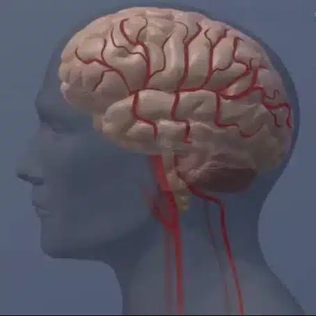 Cientistas revelam como os efeitos da psicose se espalham pelo cérebro