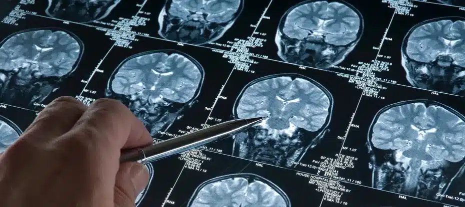 Médicos descobrem agulha alojada no cérebro de mulher de 80 anos