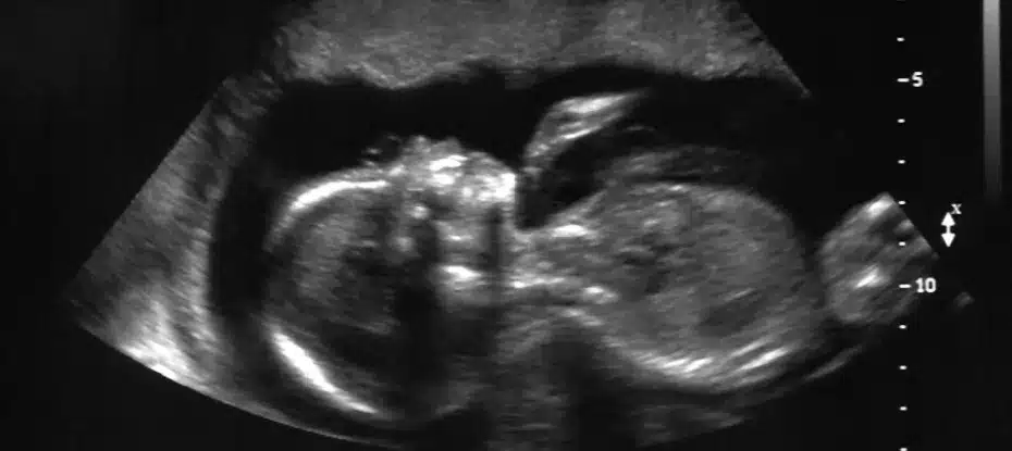 Curioso: Mulher americana com útero duplo raro está grávida em ambos
